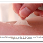 istock_photo_of_sunburn_peeling.png